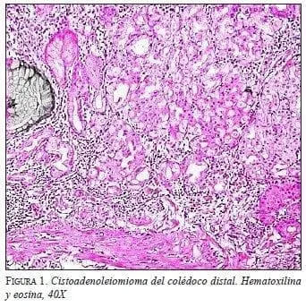 Cistoadenoleiomioma del Colédoco Distal. Hematoxilina y eosina, 40X