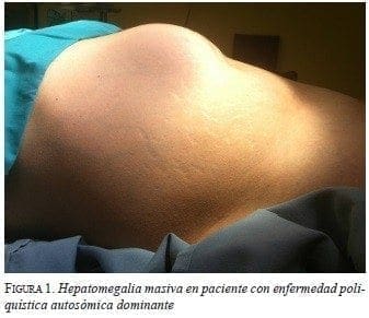 Hepatoesplenomegalia masiva en un paciente con enfermedad de