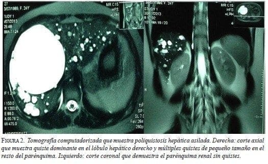 Tomografía Computadorizada que muestra Poliquistosis Hepática Asilada