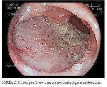 Úlcera posterior a Disección Endoscópica Submucosa