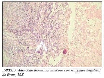 Adenocarcinoma Intramucoso con márgenes negativos
