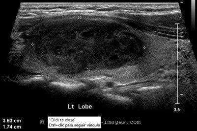 Carcinoma papilar en el lóbulo izquierdo