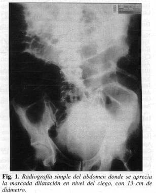 Radiografía de Abdomen