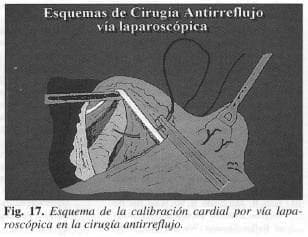 Calibración cardial