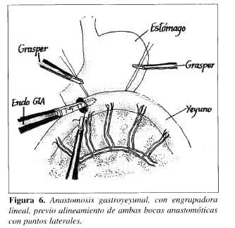 Anastomosis Gastroyeyunal, con Engrapadora Lineal