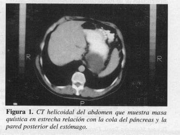 CT Helicoidal del Abdomen