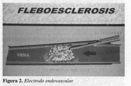 Electrodo Endovascular