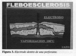 Electrodo dentro de una perforante