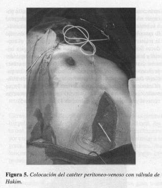 Colocación del Catéter Peritoneo-venoso con válvula de Hakim