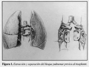 Extracción y Separación del Bloque Pulmonar Previos al Trasplante