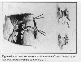 Anastomosis Arterial Terminoterminal