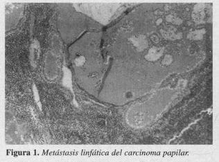 Metástasis Linfática del Carcinoma Papilar