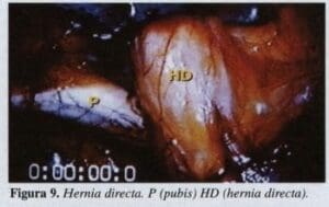 Hernia Directa