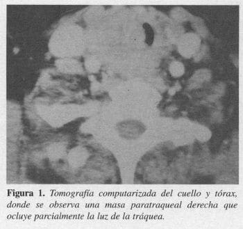 Tomografia computarizada del Cuello y Tórax