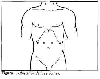 Tratamiento Laparoscópico, Ubicación de los trocares.