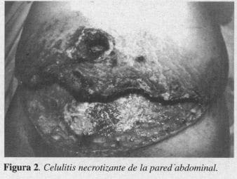Celulitis Necrotizante de la pared Abdominal