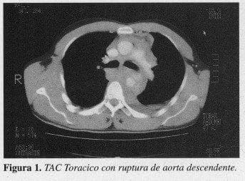 TAC Toracico con ruptura de Aorta descendente