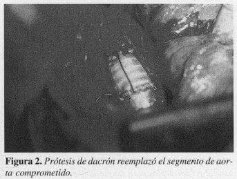 Prótesis de Dacrón reemplazó el segmento de Aorta comprometido