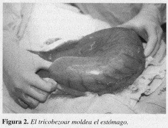 El Tricobezoar Moldea el Estómago
