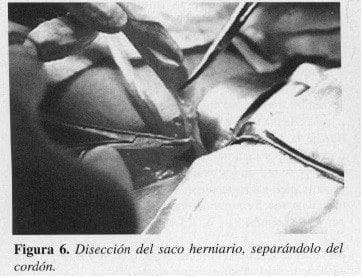 Disección del saco herniario, separándolo del cordón