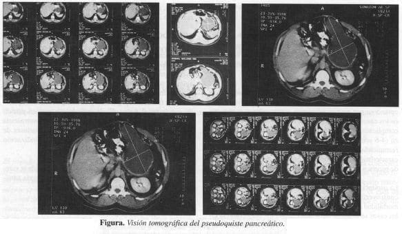 Visión Tomográfica del Pseudoquiste Pancreático