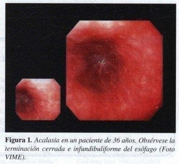 Acalasia en un Paciente de 36 años