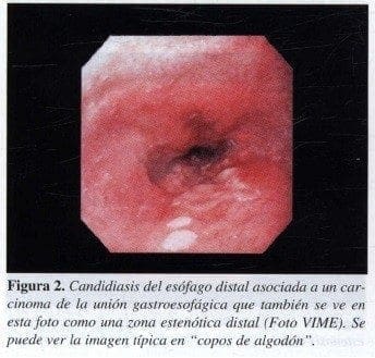 Candidiasis del Esófago Distal asociada a un Carcinoma de la Unión Gastroesofágica