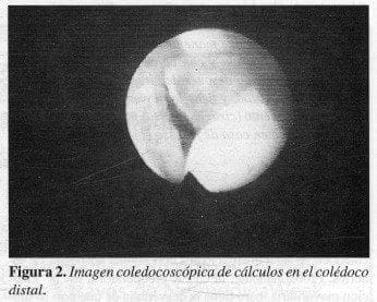 Imagen Coledocoscópica de Cálculos en el Colédoco Distal