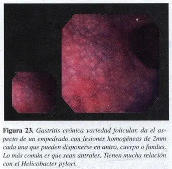 Gastritis Crónica variedad Folicular