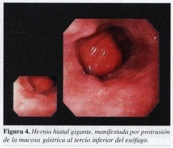 Hernia Hiatal Gigante