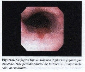 Esofagitis Tipo II