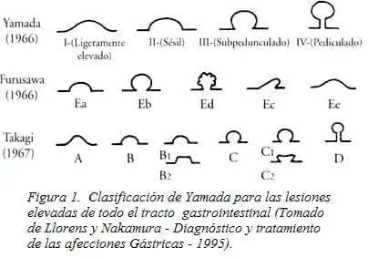Clasificación de Yamada para las Lesiones elevadas de todo el Tracto Gastrointestinal