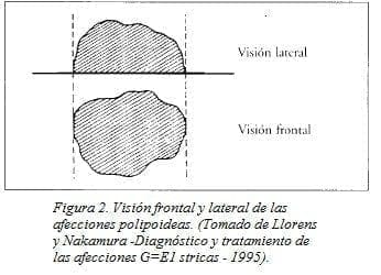 Visión Frontal y Lateral de las Afecciones Polipoideas