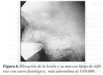 Elevación de la Lesión y su Mucosa