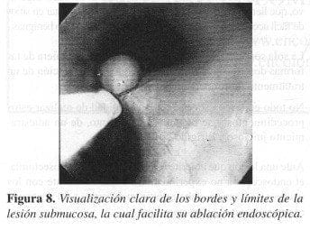 Visualización Clara de los Bordes y Límites de la Lesión Submucosa