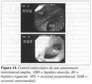 Control Endoscópico de una Anastomosis Laterolateral amplia
