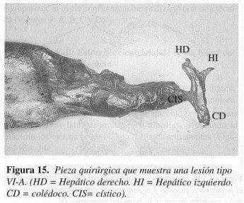 Pieza Quirúrgica que muestra una Lesión tipo VI-A