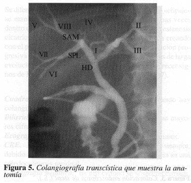 Colangiografía Transcística que muestra la Anatomía