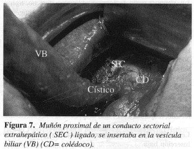 Muñón Proximal de un conducto Sectorial Eextrahepático