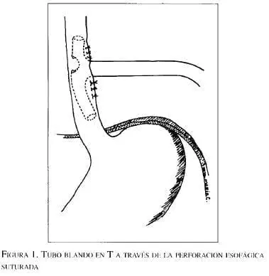Tubo blando a través de la performación esofágica saturada