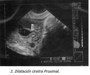 Dilatación Uretra Proximal