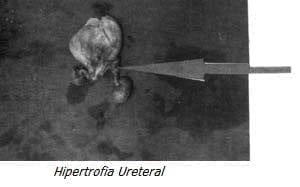 Hipertrofia Ureteral