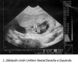 Dilatación Unión Urétero Vesical Derecha e Izquierda