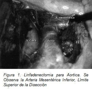 Linfadenectomía para Aortica