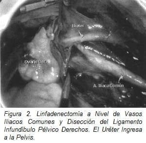 Linfadenectomía a Nivel de Vasos Iliacos Comunes