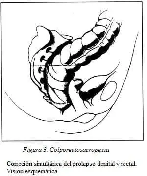 Colporectosacropexia