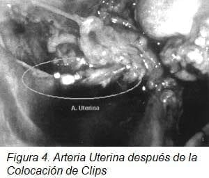 Arteria Uterina después de la Colocación de Clips