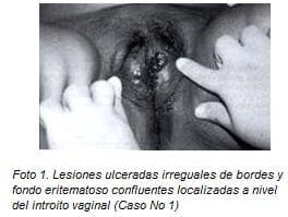 Lesiones Ulceradas Irregulares