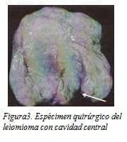 Espécimen Quirúrgico del Leiomioma con Cavidad Central