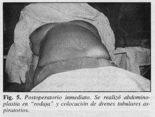 Abdominoplastia en "Rodaja" y colocación de Drenes Tubulares Aspiratorios